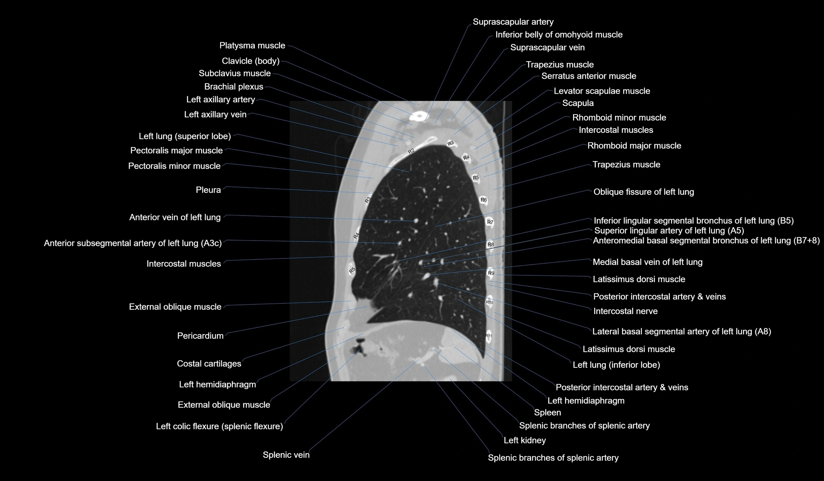 CT chest (thorax) labelled sagittal cross sectional anatomy radiology image-00108.webp
